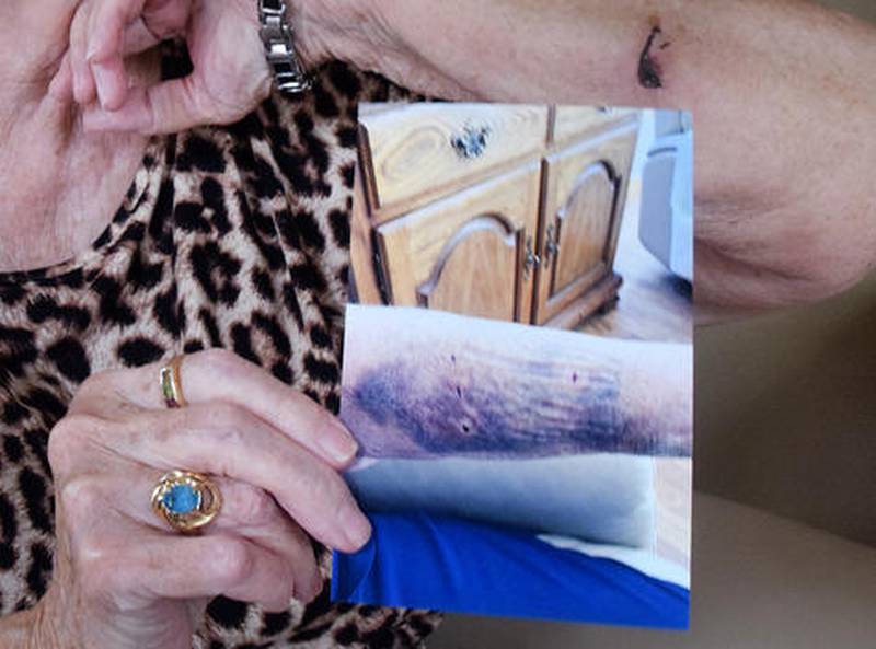 Kathy Tipton, 78, of Newton, shows a picture of her dog bite injury next to her healing arm inside her home. Kathy's husband, Max Tipton, complained to city council members about Newton's vicious dog ordinance, suggesting it needs more teeth to help victims of dog bites.